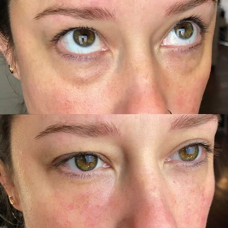 Dark Circles comparison photos accompanying Alicia R.’s review