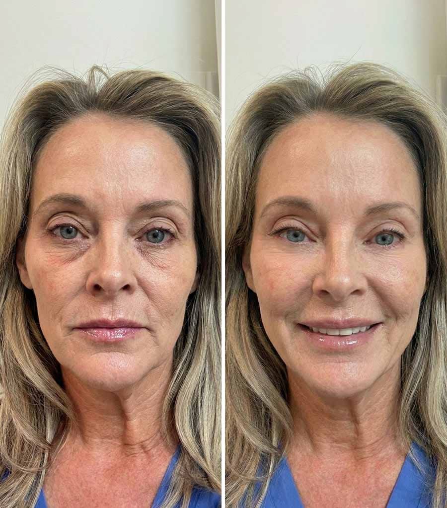 Looking Younger comparison photos accompanying Hannah M.’s review
