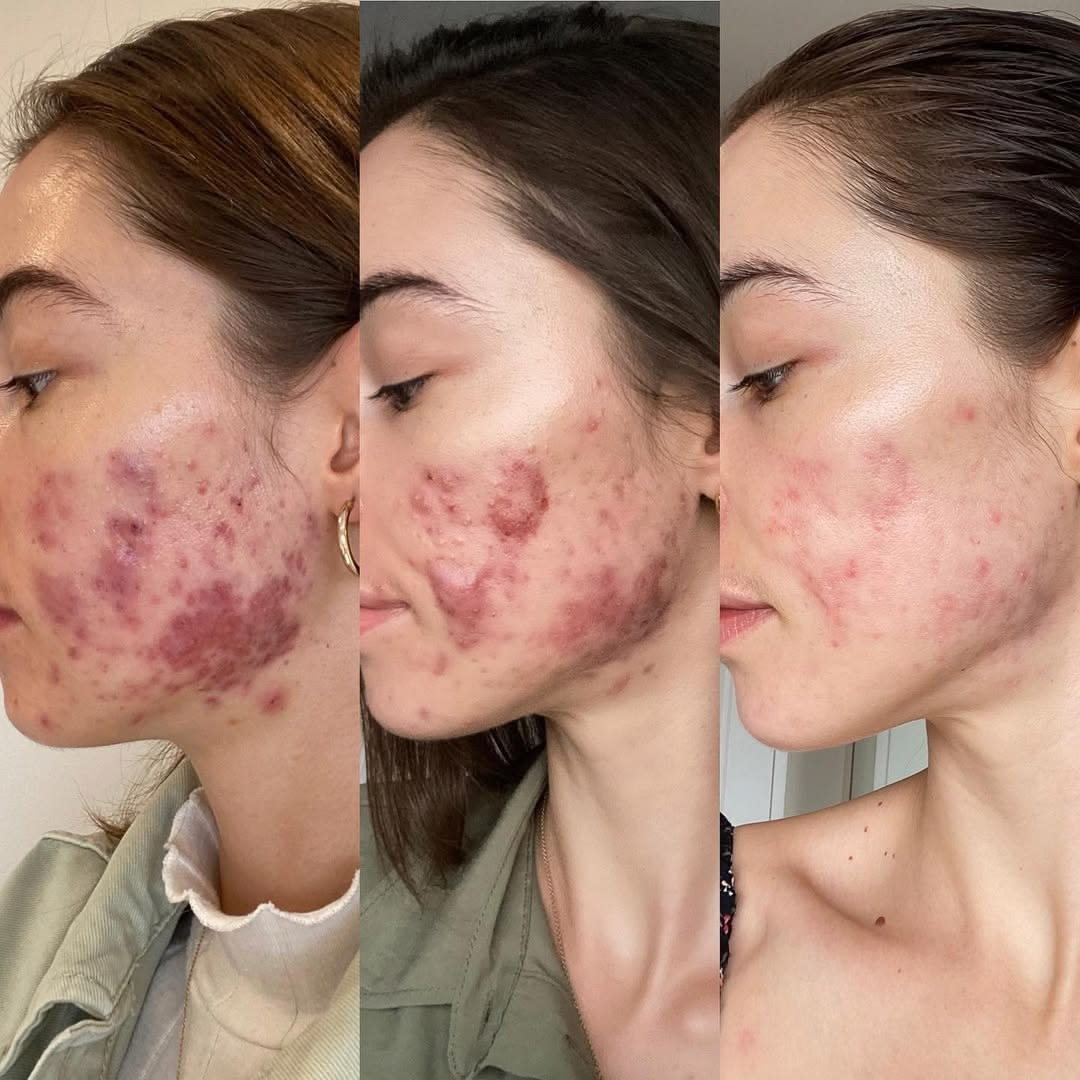 Acne + Breakouts comparison photos accompanying Jasmine C.’s review